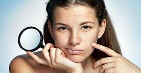 Best Diet to Stay Away From Acne