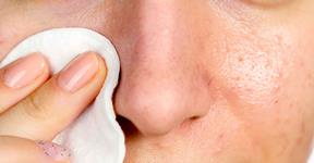Dealing with Blackheads Effectively