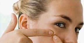 What Are Causes Of Pimples