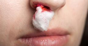 Nose Bleeding in Summer and Its Home Treatment
